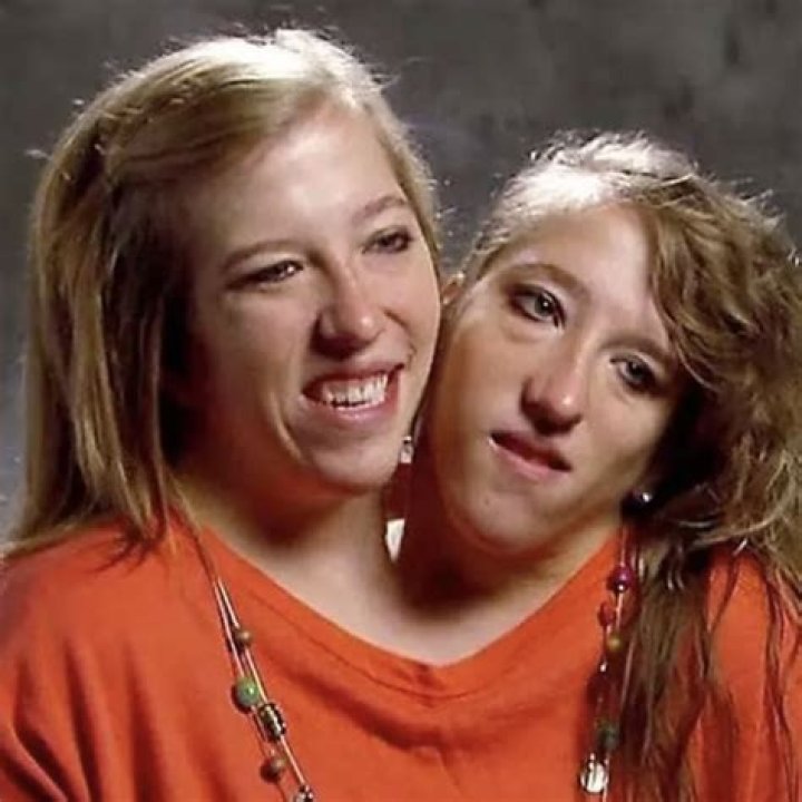 Unraveling the Lives of Conjoined Twins Abby and Brittany