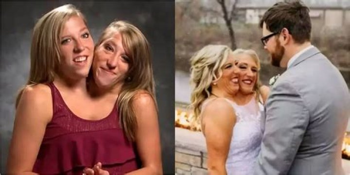 Conjoined Twins Get Married: A Unique Love Story