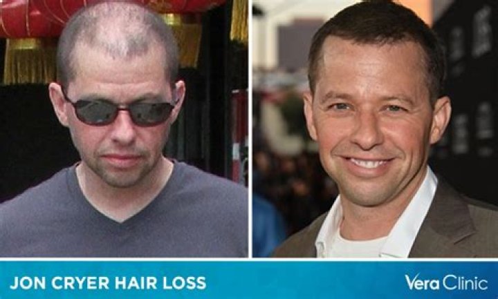 Did Jon Cryer Shave His Head? Unraveling the Mystery
