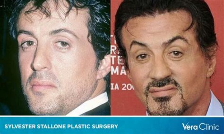 Did Sylvester Stallone Have a Stroke? Exploring the Truth Behind the Rumors
