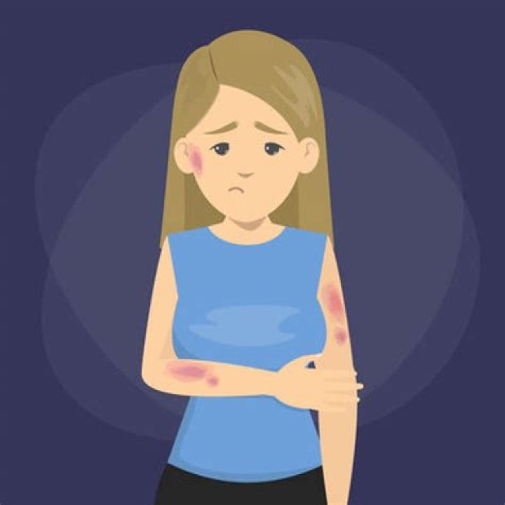 Do Hickeys Cause Cancer? Exploring the Myth and Facts