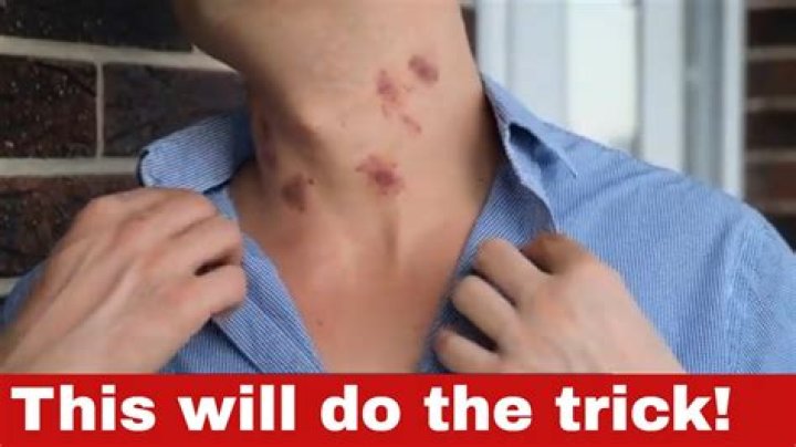 Does Hickeys Cause Cancer? Debunking the Myth and Exploring the Truth
