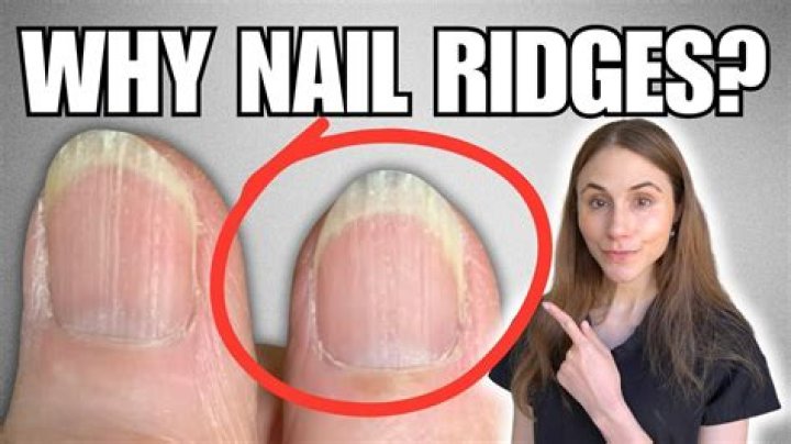 Nail Ridges Remedy: Comprehensive Guide to Understanding and Treating Nail Ridges