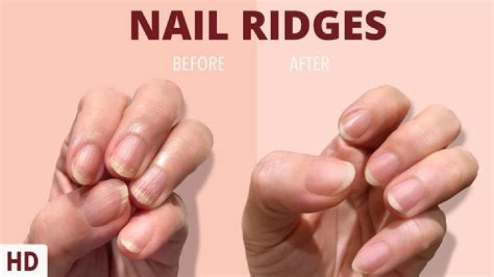 Nail Ridges Treatment: Comprehensive Guide for Smooth and Healthy Nails