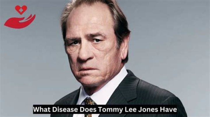 What Disease Does Tommy Lee Jones Have? Uncovering the Truth Behind the Rumors